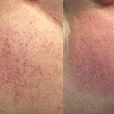 Удаление сосудистых звездочек на лице