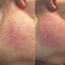 Удаление сосудистых звездочек на лице - превью 1